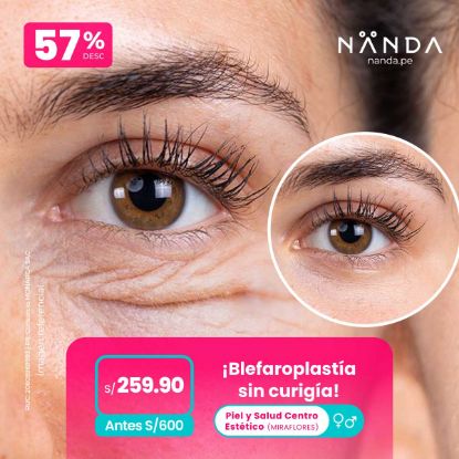 ¡Blefaroplastía sin curigía! 😍 - Piel y Salud Centro Estético (MIRAFLORES)