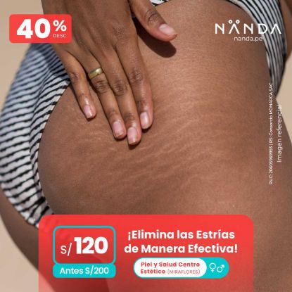 ¡Elimina las Estrías de Manera Efectiva! 😍 - Piel y Salud Centro Estético (MIRAFLORES)