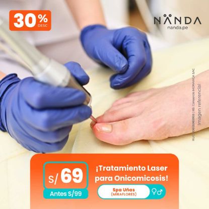 ¡Tratamiento Laser para Onicomicosis! 😍 - Spa Unas (CAMACHO)