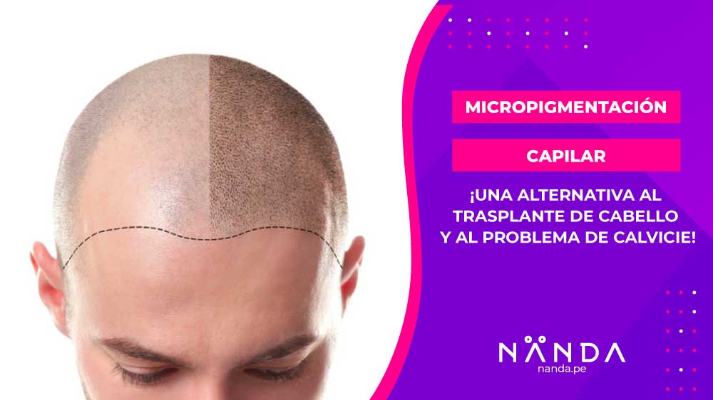 MICROPIGMENTACION CAPILAR ¡La mejor alternativa al problema de calvicie!